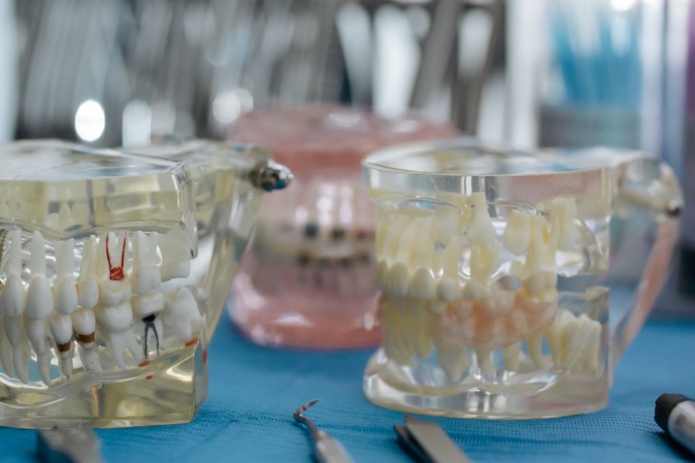 Can a Cracked Tooth Be Saved? The Five Crack Types Explained