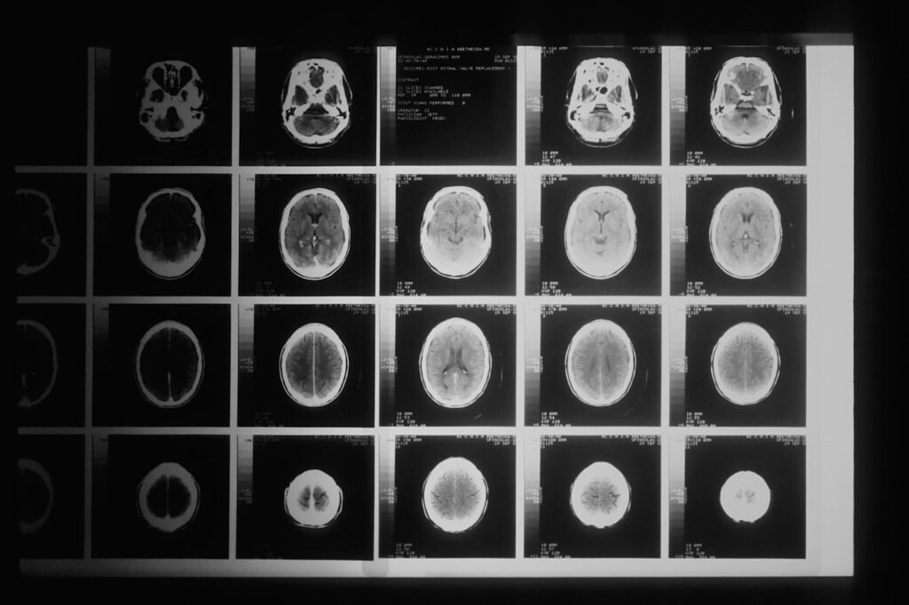 3D imaging often reveals the canal that was missed first time