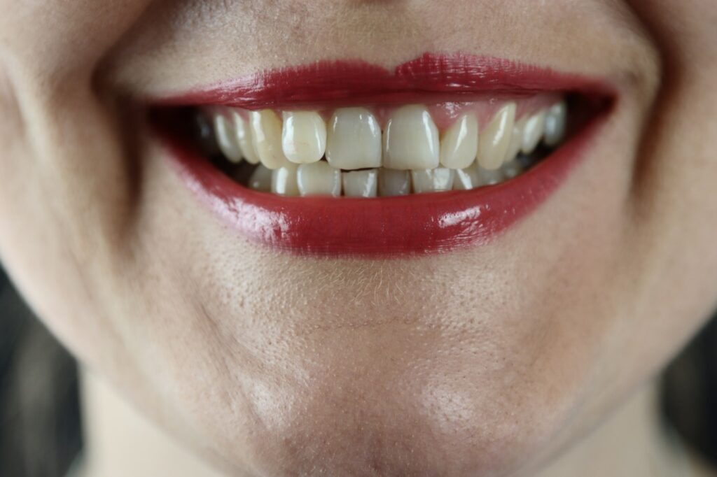 A chip confined to enamel is cosmetic; a chip exposing dentine is not