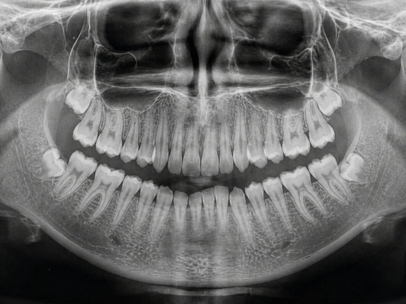 Most cracks do not show on a standard X-ray, which is why testing matters