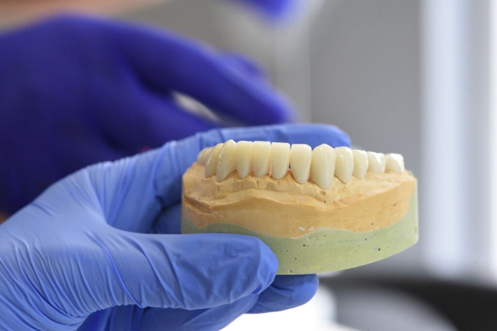 The crown is a separate cost and is rarely optional on a molar