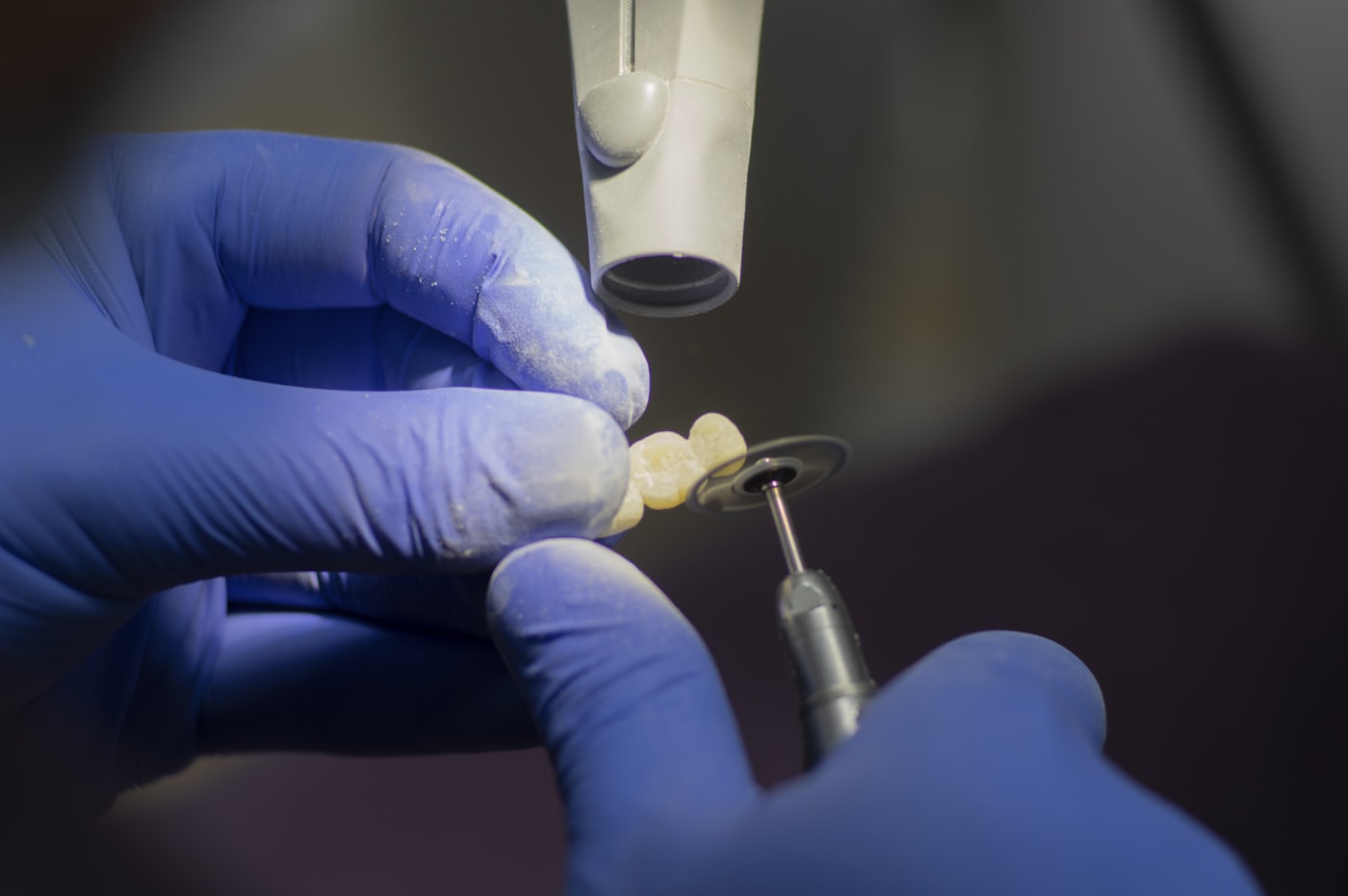 A full-coverage crown holds a cracked tooth together under chewing load