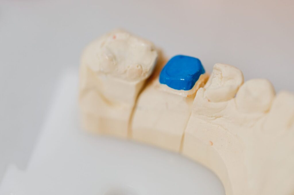 Do You Need a Crown After a Root Canal?