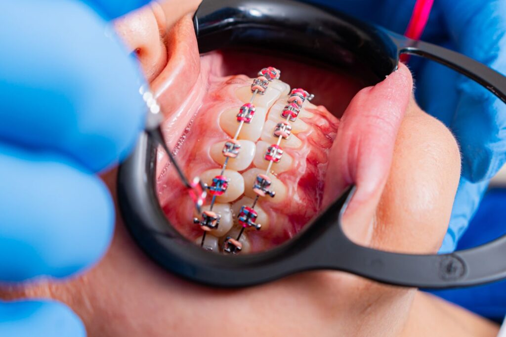 A flexible splint holds the tooth while the ligament reattaches