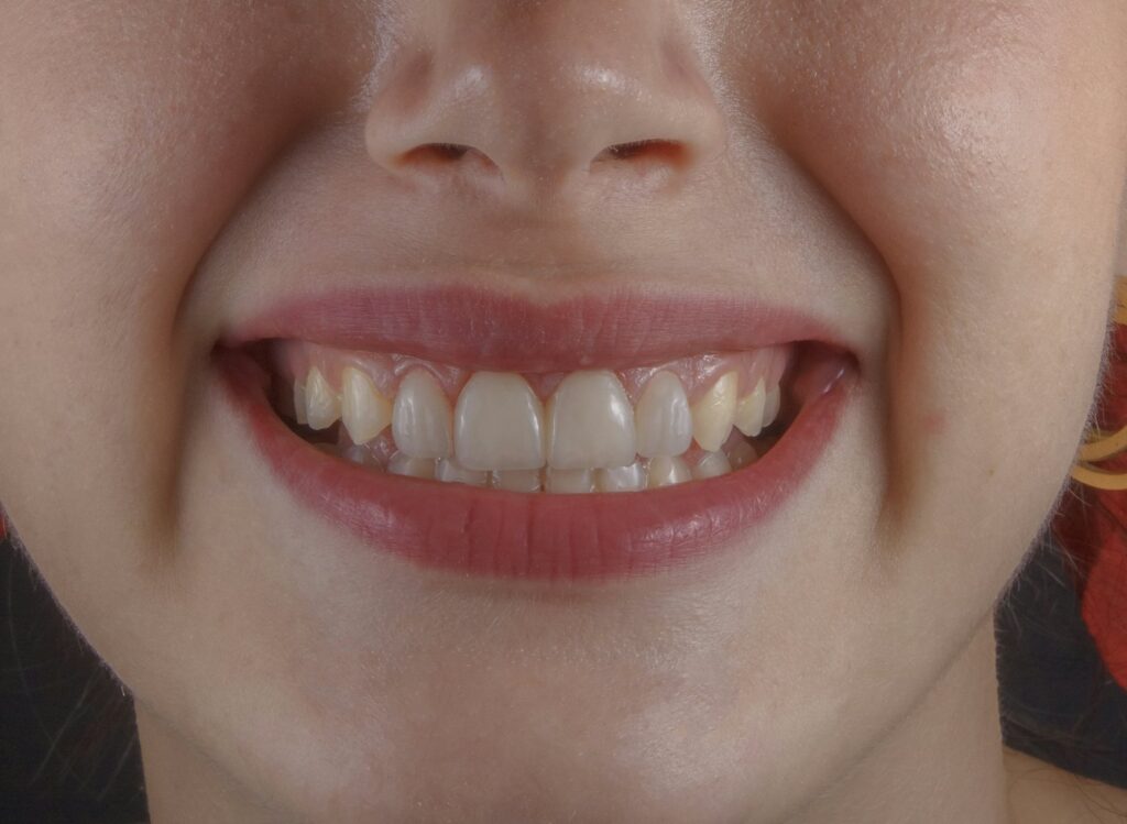 A front tooth with little damage often does not need full coverage