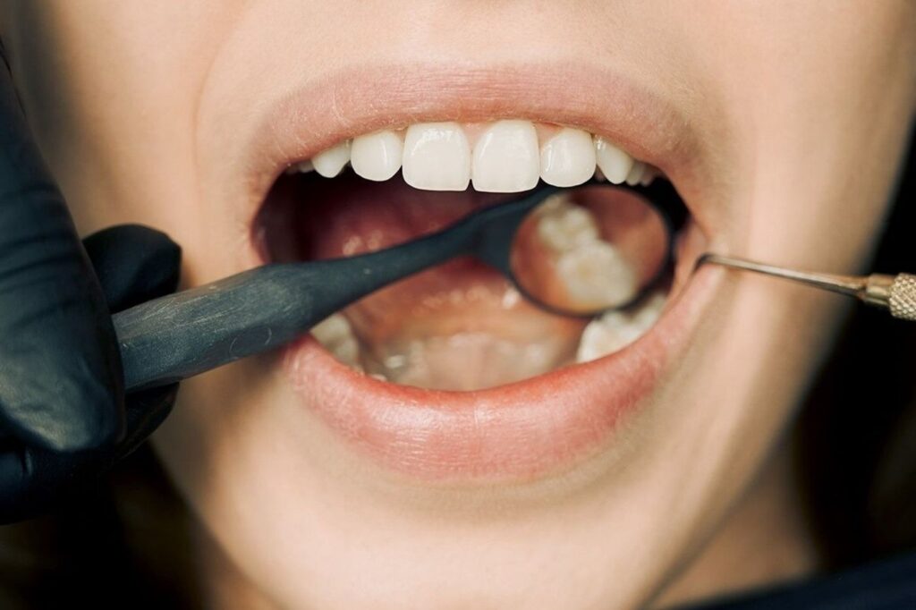 A recurring gum boil is drainage finding its own way out