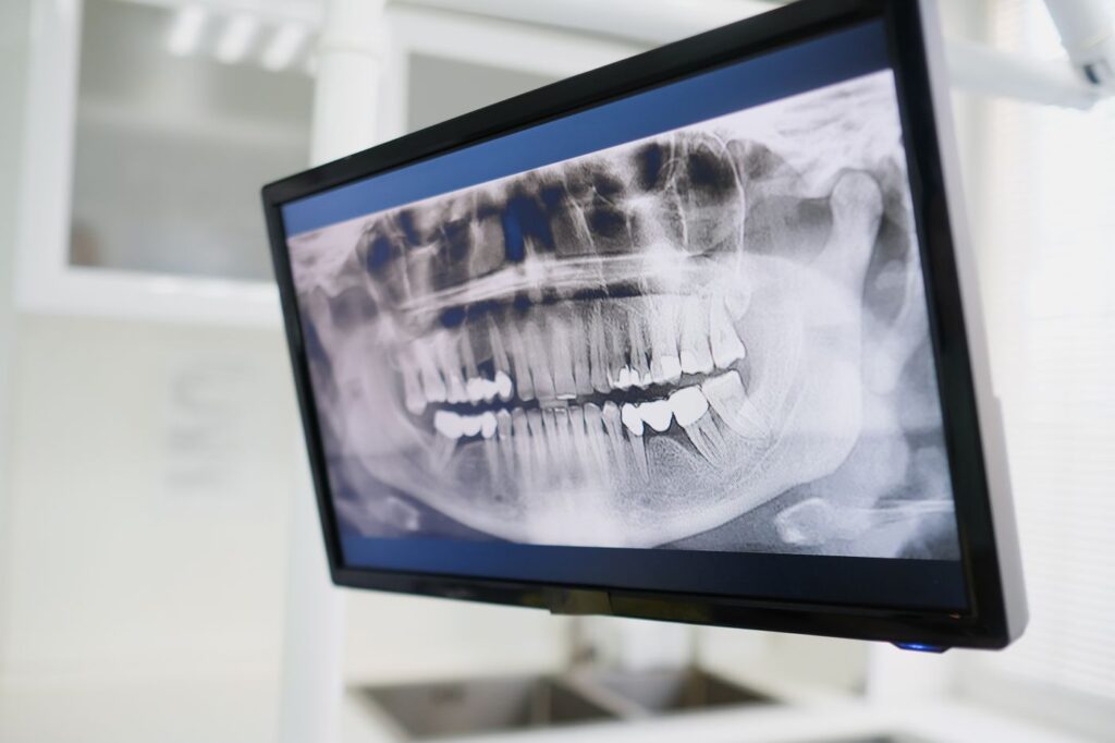 A standard radiograph compresses a three-dimensional root into a flat image