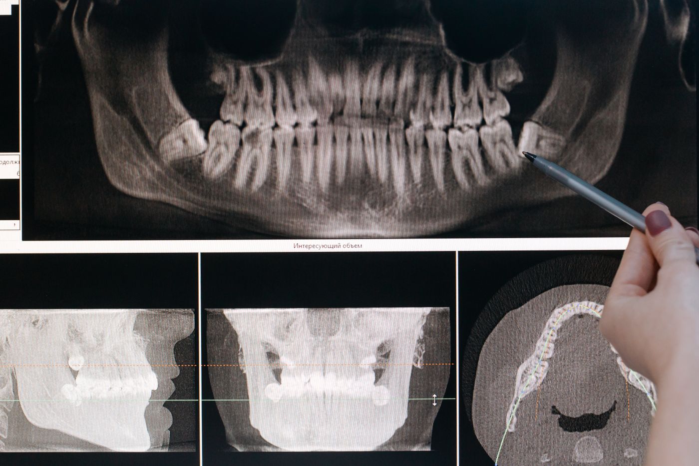 Tooth Resorption: When a Tooth Dissolves From Within